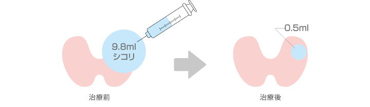 図：液の溜まった袋（嚢腫）に対する治療